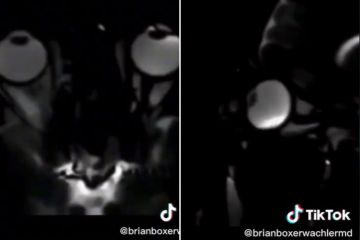 Vídeo chocante revela por que você nunca deve esfregar os olhos se estiver cansado